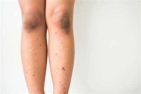 Dark Liver Spots On Legs Sexiezpicz Web Porn