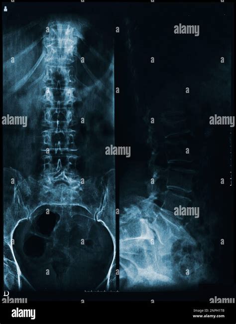 Columna Vertebral Y Pelvis De Una Radiografía Del Cuerpo Humano Vista