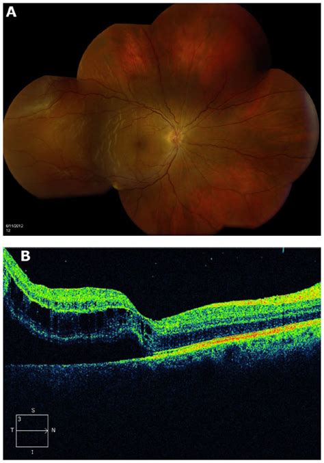 Retinal tears may lead to shadows in your vision, flashing bright lights when you move your eyes how are tears treated? Spectral-domain optical coherence tomography imaging of ...