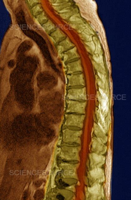 Photograph Lumbar Compression Fracture Mri Science Source Images