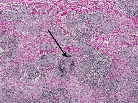 Annular Elastolytic Giant Cell Granuloma Mysterious Enlarging Scarring