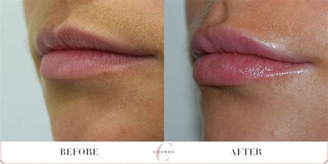 Lip Enhancement Before And After Cosmos Clinic