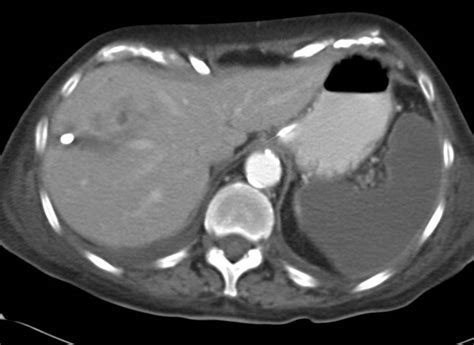 Global Splenic Infarct In A Patient With A Liver Abscess Spleen Case