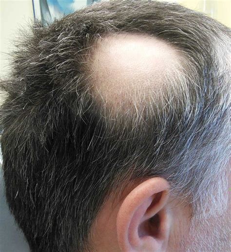 Scalp Micropigmentation For Bald Spots Scalp Micro Portugal