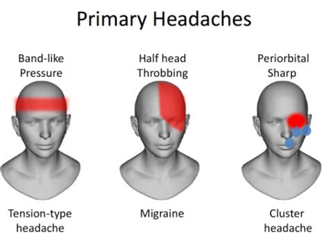 Beautiful Headache Location Chart With Types Of Headache Chart Hola