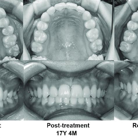 Occurrence Of Significant Crown Lingual Torque And Gingival Recession