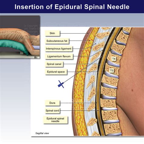 Insertion Of Epidural Spinal Needle Trialexhibits Inc