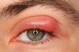 Images of Swollen Bottom Eyelid Home Remedies