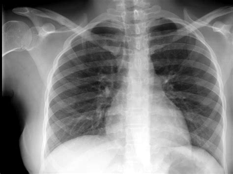 Ct angiography (cta) is a diagnostic tool used to locate tumors in the body, determine whether cancer has spread, and detect abnormal blood vessels that may indicate a health risk. Lung cancer deaths not prevented by routine X-rays, study ...