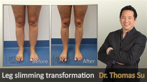 Lipedema Surgery Liposuction Lipo 360 Cankles And Knees Ankles Calves Legs Expert Dr Su