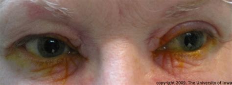 Scaly Skin On Eyelid Pictures Photos