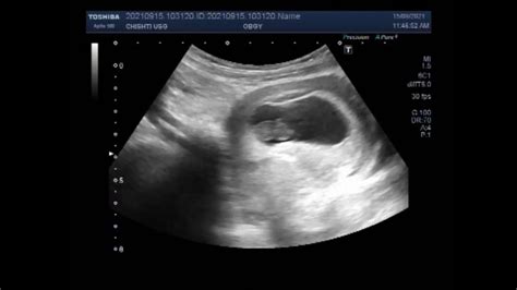Twin Pregnancy Of 9 Weeks With One Blighted Ovum And The Other Missed
