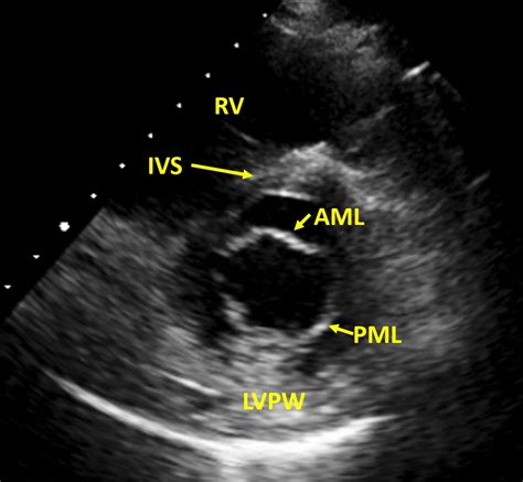 Normal Mitral Valve Cross Section On Echocardiography All About