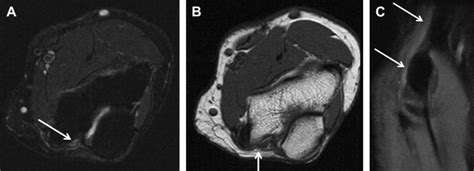 High Resolution Magnetic Resonance Neurography In Upper Extremity
