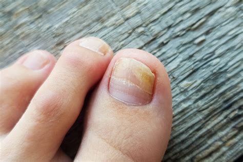 Fungal Nail Infections Onychomycosis Treatment At The Foot Practice