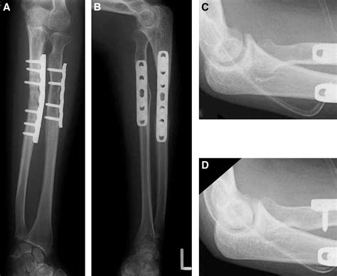 Corrective Osteotomy For Malunited Both Bones Fractures Of The Forearm
