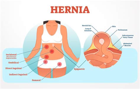 Hernia Symptoms Causes Treatment And Prevention Medlife Blog