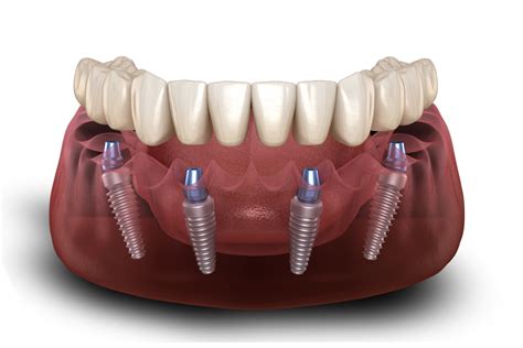 Full Mouth Dental Implants Indianapolis Georgetown
