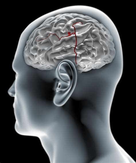 Read about brain aneurysm (cerebral aneurysm) symptoms, signs, surgery, causes, survival rates, recovery, treatment, coiling, prognosis, survival rate, statistics, rupture, and more. What is a cerebral aneurysm or brain aneurysm ...
