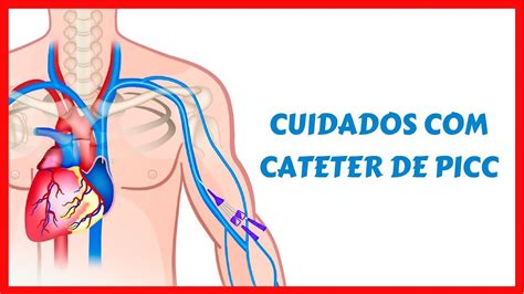 Cuidados De Enfermagem Com Cateter De Picc Youtube