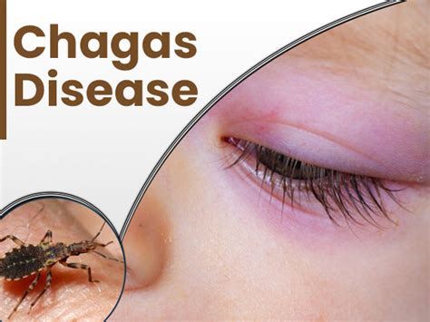 Chagas Disease Causes Epidemiology And Treatment