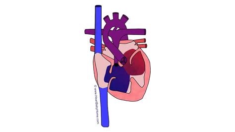 78 Animated Tetralogy Of Fallot Cavc Pulmonary Atresia Youtube