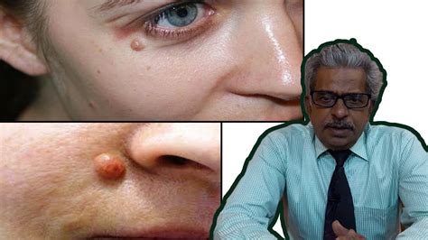 Wart Remedy In Homeopathy By Dr Ps Tiwari मस्सा हटाने के उपाय