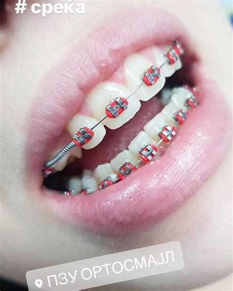 Top 10 Colored Of Red Braces For Handsome Teenage Boys Braces Explained