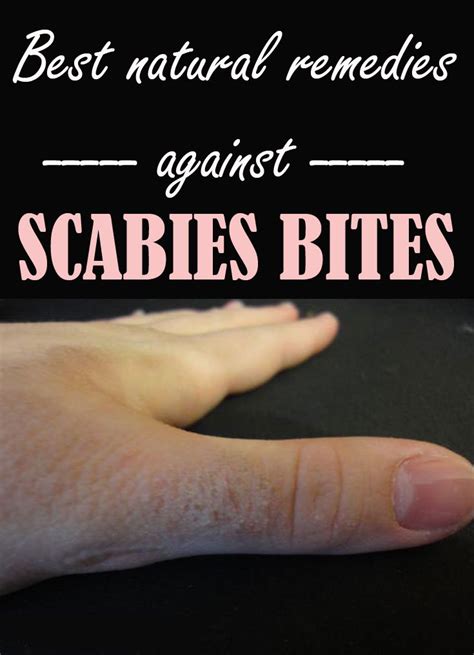 Best Natural Remedies Against Scabies Bites In 2020 Natural Remedies