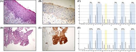 Immunohistochemical Staining Of P16 In Samples From Patients With