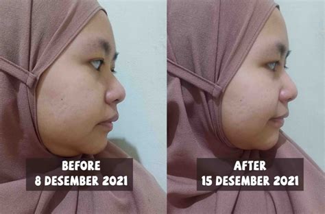 Review Treatment ERHA Ultimate Acne Cure Program di ERHA Clinic Bogor