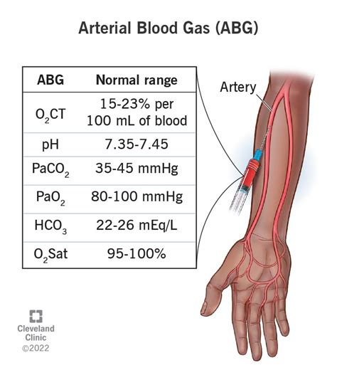 Arterial Blood Gas ABG What It Is Purpose Procedure Levels