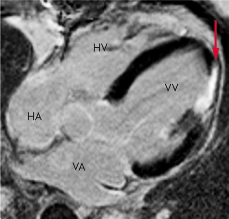 cardiac mri scan after injection of gadolinium based contrast the left download scientific