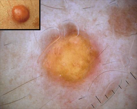 Dermoscopy Of Solitary Yellow Lesions In Adults Dermatology Jama