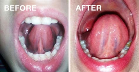 Restrictive Lingual Frenulum Almost Everyone Has A Frenulum Under The Tongue And Top Lip What