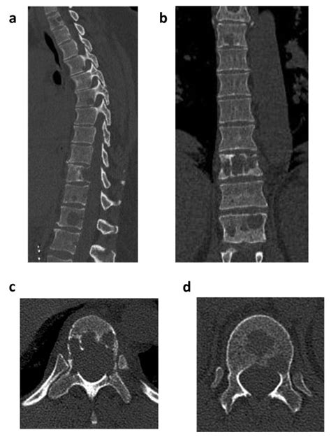 Computed Tomography Ct Of The Thoracic Spine Sagittal A And