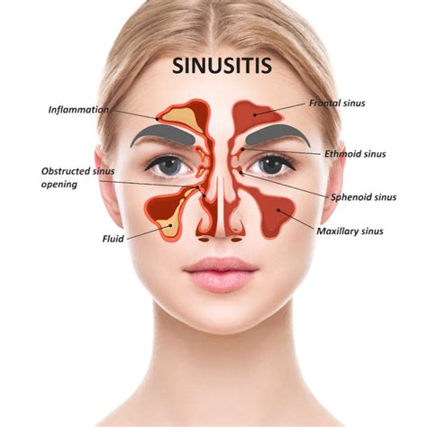 How To Manage Sinusitis Naturally Natural Medicine World