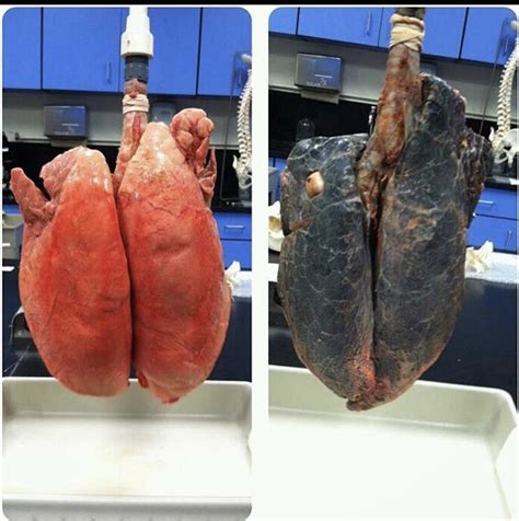 Others do have symptoms but, because those symptoms are so vague Smoker vs nonsmoker's lungs : nursing