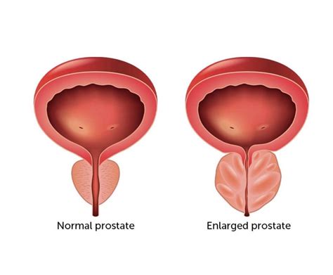 The Best Treatment For Benign Prostatic Hyperplasia Aquablation Therapy World Today News