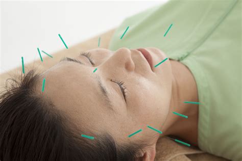 Why Medical Acupuncture Is So Beneficial Englinton Medical Pc