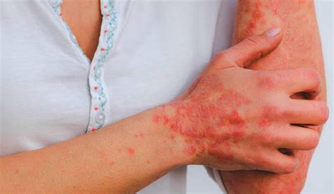 4 Plaque Psoriasis Symptoms What It Looks And Feels Like According To