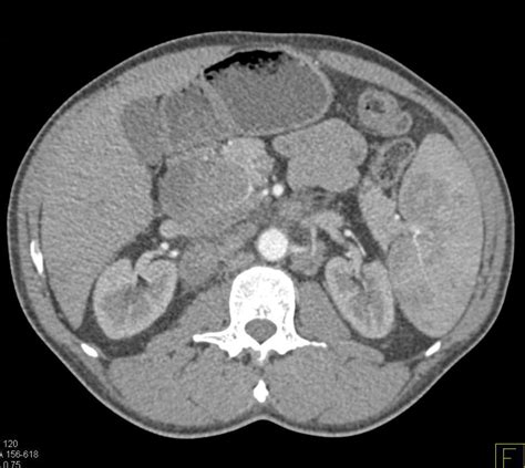 Lymphoma With Splenic Involvement And Extensive Adenopathy