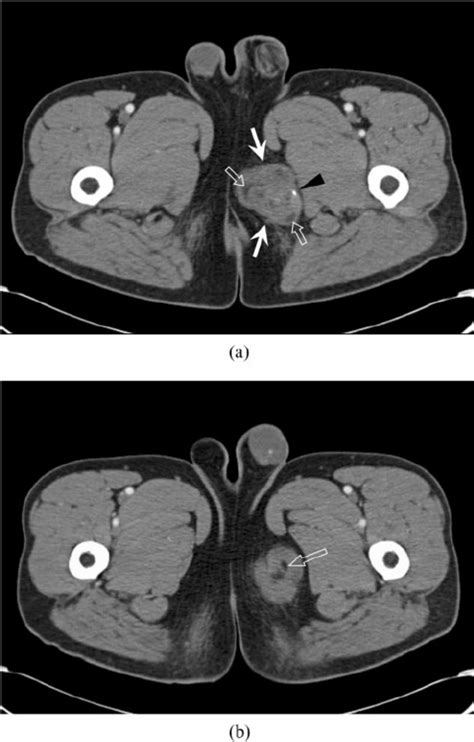 A Contrast Enhanced Ct Shows A Well Defined Lobulated Heterogeneous