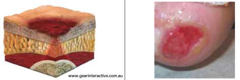Maceration meaning.there are 2 meaning(s) of maceration.extreme leanness (usually caused by what is the meaning of maceration. Related Keywords & Suggestions for excoriation coccyx