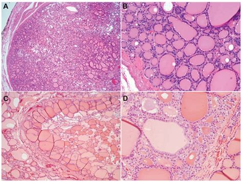 Histopathologic Features Of Eif1ax Positive Benign Thyroid Nodules Ab