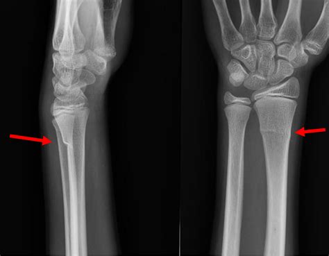 Greenstick Fracture X Ray