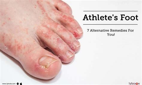 What Is The Best Antifungal For Athlete S Foot Tutorial Pics