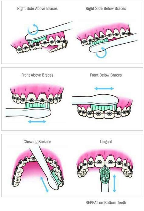 At face value, this sounds like a bad thing. Braces help | Getting braces, Dental braces, Orthodontics ...