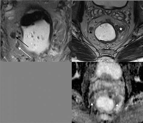 Ct And Mri Of The Pelvis For Anorectal Disease Abdominal Key