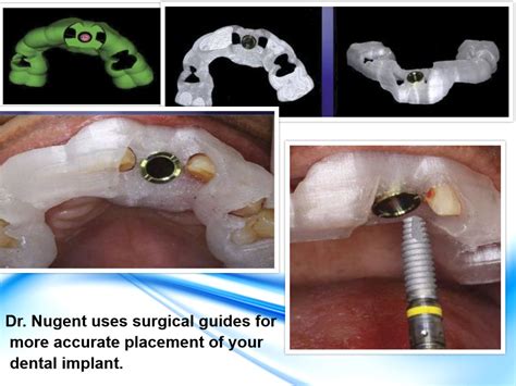 Guided Dental Implant Surgery Conebeam 3 D Xray